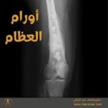 كتاب أورام العظام